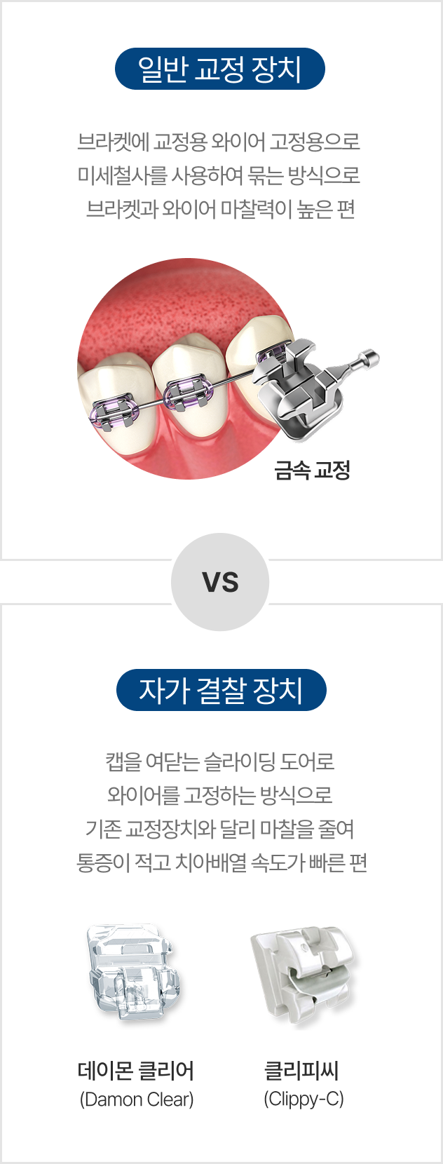 일반교정장치와 자가결찰장치의 차이
